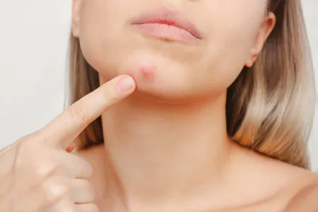 Nguyên nhân nổi mụn dưới cằm và cách điều trị